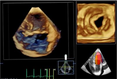 3D echocardiography: ventricle and mitral valve