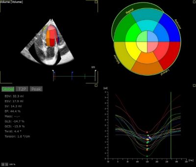 3D echocardiographic image: left ventricular analysis