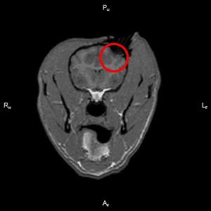 Time lapsed MRI depicting a CED infusion into the subcortical white matter of the canine brain. In this case, the therapeutic drug is tagged to a gadolinium-based contrast agent, so that the volume of distribution of the infusate is visible on the MRI as a “white plume” against the dark background of the brain, which enlarges over time. Monitoring CED treatments in real time with this technique allows clinicians to confirm that the target region was accurately infused.